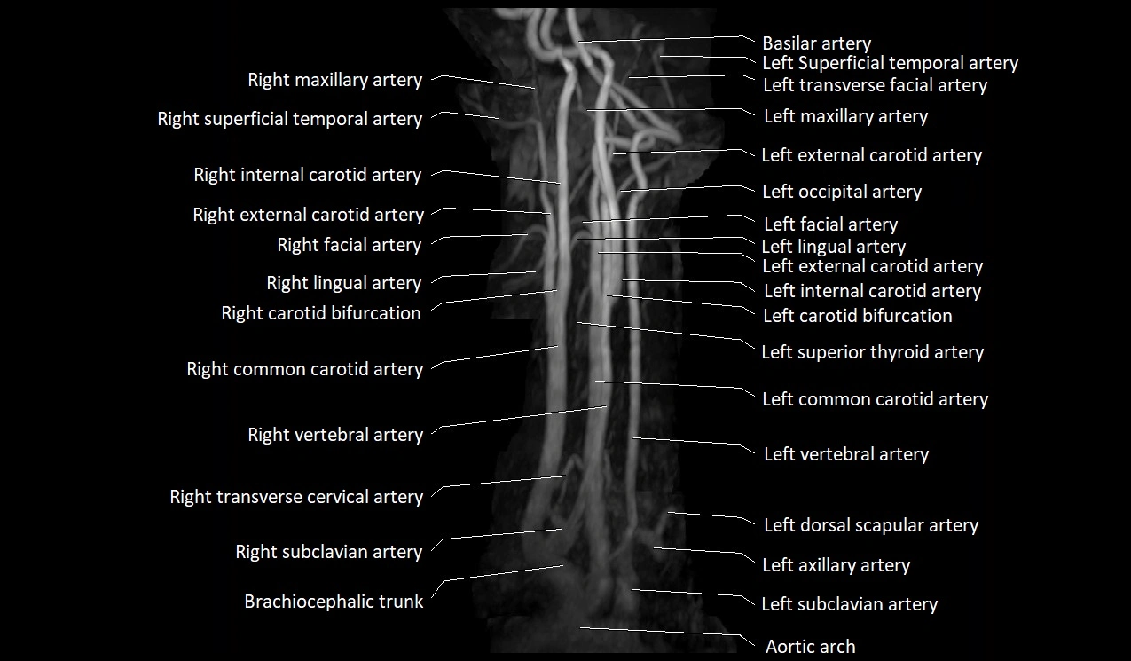 MRA neck carotid arteries labeled anatomy image MIP 3D image 1.webp
